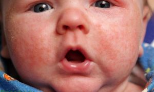 Народные средства от аллергии у детей
